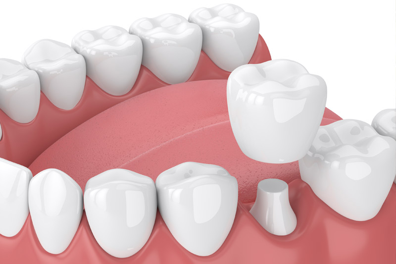 Dental Crowns in Holland