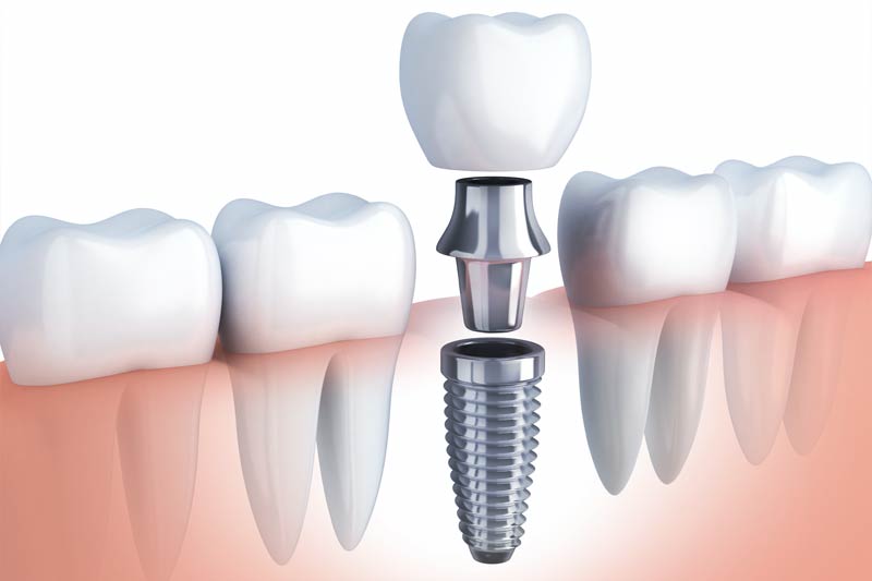 Implants Dentist in Holland