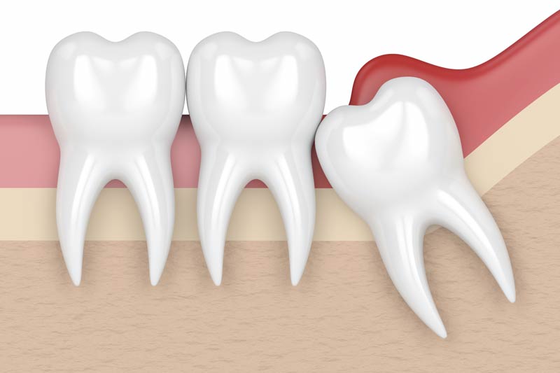 Wisdom Tooth Removal in Holland